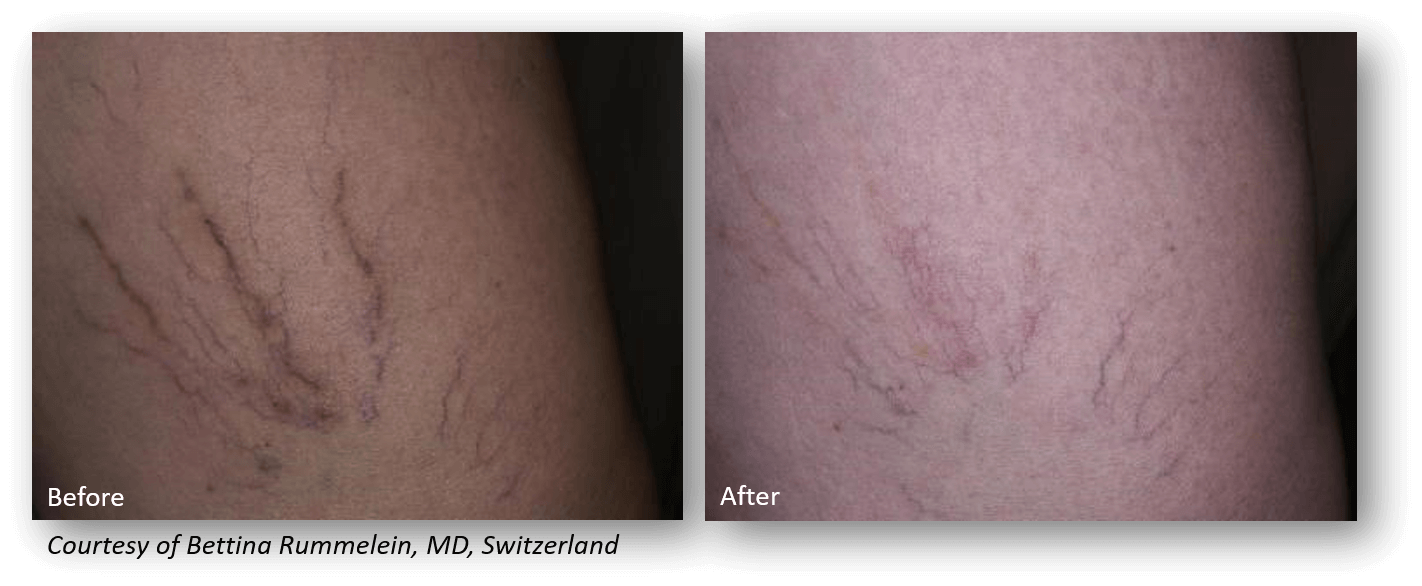 Spider Vein Removal with the Lutronic Laser at StadiaMedSpa