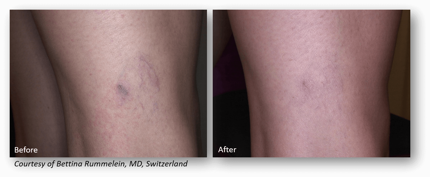 Spider Vein Removal with the Lutronic Laser at StadiaMedSpa